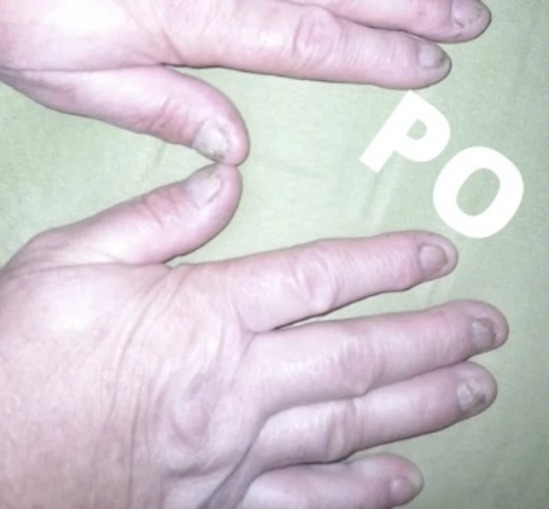Ruce s nehty postiženými plísní, zbarvené a poškozené
