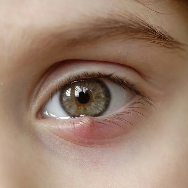 Detailní fotografie lidského oka s ječným zrnem na dolním víčku.