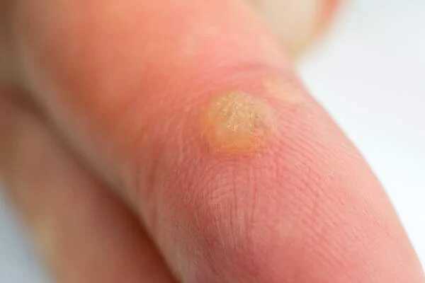 Finger wart lesion